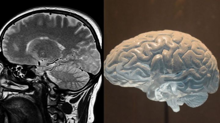 COVID: ¿Te sientes más "lento"? Virus podría afectar al cerebro... aún en casos leves