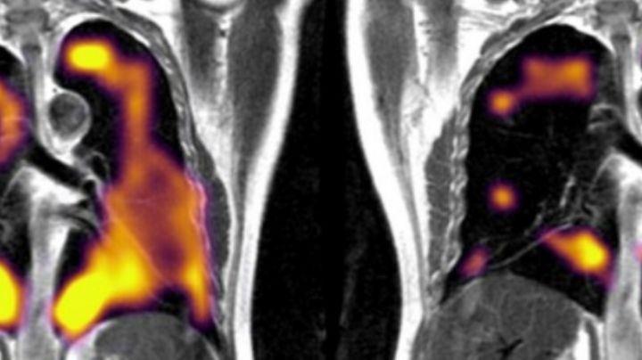 COVID largo: así lucen tus pulmones si lo padeces