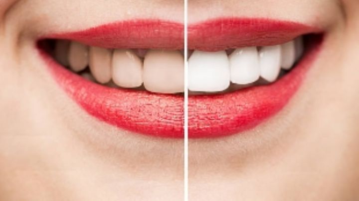 Dientes blancos: ¿por qué no deberías blanquearlos?