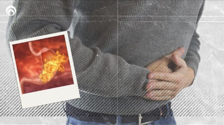 Gastritis: ¿Cuáles son los síntomas y cómo tratarla?