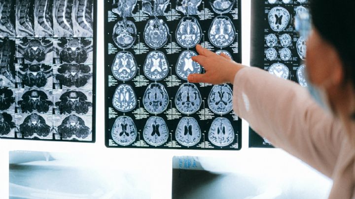 COVID está provocando inflamación cerebral... en personas no infectadas