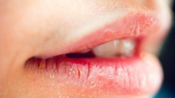 ¿Tienes los labios partidos? 5 tips para curarlos.