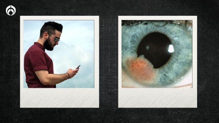 Cáncer ocular: ¿Te puede dar por estar todo el tiempo en el celular?