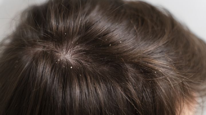 ¿Tienes caspa? 3 remedios naturales para eliminarla y lucir un cabello radiante