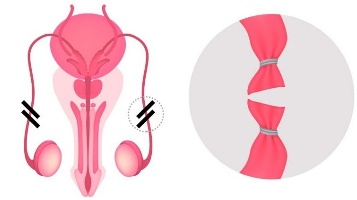 Vasectomía: jóvenes buscan este procedimiento como ¿método anticonceptivo?