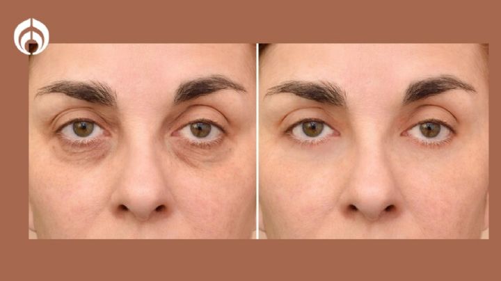 Tratamientos más efectivos para las ojeras, según expertos