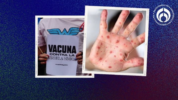 Viruela del mono: estos son los estados con más casos de Mpox en México