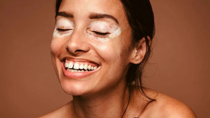 Inspiración familiar hecha ciencia: joven crea crema innovadora que controla el vitiligo