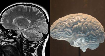 COVID: ¿Te sientes más "lento"? Virus podría afectar al cerebro... aún en casos leves