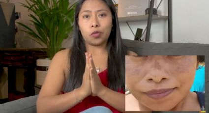 Melasma, esta es la enfermedad de Yalitza Aparicio que manchó su rostro