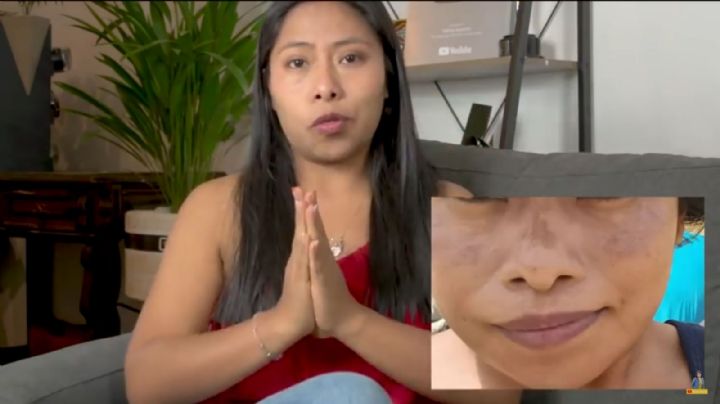 Melasma, esta es la enfermedad de Yalitza Aparicio que manchó su rostro