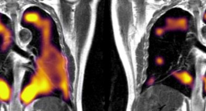 COVID largo: así lucen tus pulmones si lo padeces