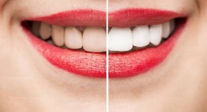 Dientes blancos: ¿por qué no deberías blanquearlos?