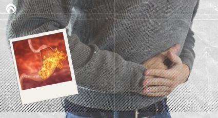 Gastritis: ¿Cuáles son los síntomas y cómo tratarla?