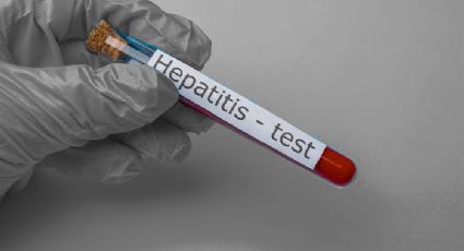 No hay ningún caso de hepatitis infantil aguda en Guanajuato