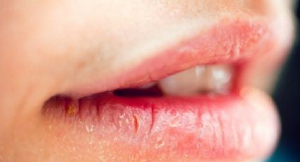 ¿Tienes los labios partidos? 5 tips para curarlos.