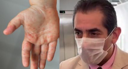 Brote de Virus de Coxsackie en Cuautla: ¿Ya fue controlado o sigue el riesgo sanitario?