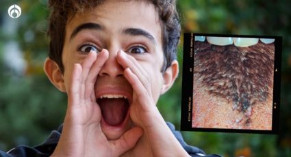 ¿Qué es la lengua vellosa negra y cómo saber si la tengo?