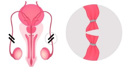 Vasectomía: jóvenes buscan este procedimiento como ¿método anticonceptivo?