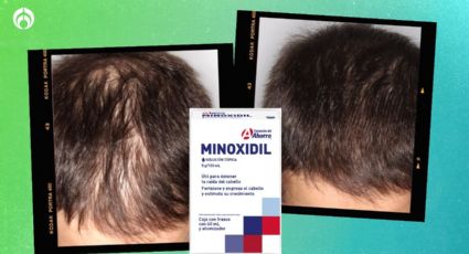 ¿Dónde comprar minoxidil más barato? El mejor aliado para evitar la calvicie