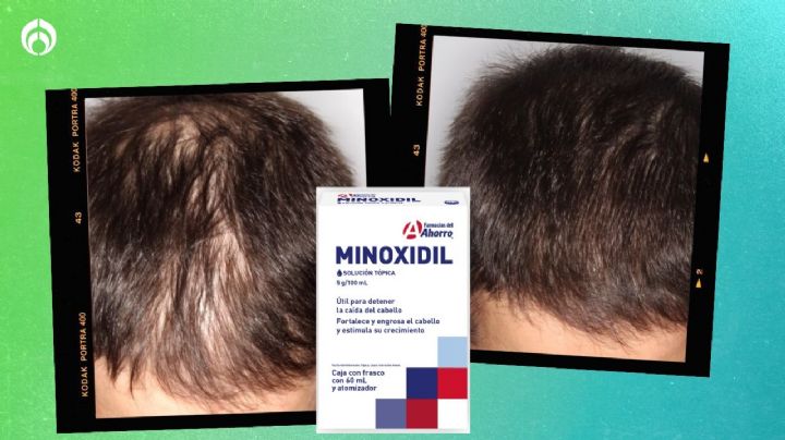 ¿Dónde comprar minoxidil más barato? El mejor aliado para evitar la calvicie