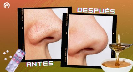 ¿Cómo usar miel y aspirina para eliminar los puntos negros y espinillas del rostro?