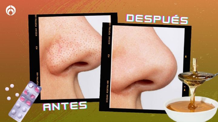 ¿Cómo usar miel y aspirina para eliminar los puntos negros y espinillas del rostro?