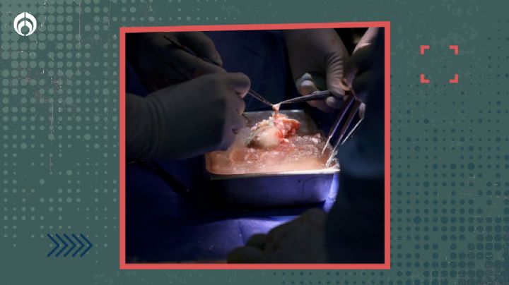 ¡Trasplante histórico!: Colocan por primera vez un riñón de cerdo a un hombre vivo en EU