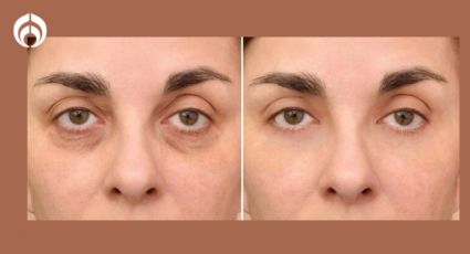 Tratamientos más efectivos para las ojeras, según expertos