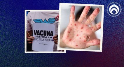 Viruela del mono: estos son los estados con más casos de Mpox en México