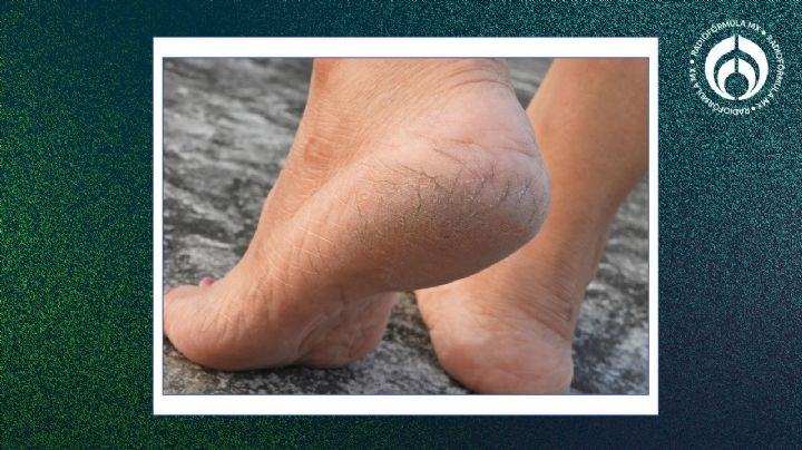 El secreto de los dermatólogos que sí funciona para los pies agrietados con cosas fáciles de conseguir