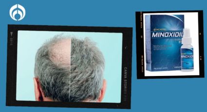 ¿Qué tan bueno es el Minoxidil para la calvicie y para crecer la barba? Esto dicen expertos